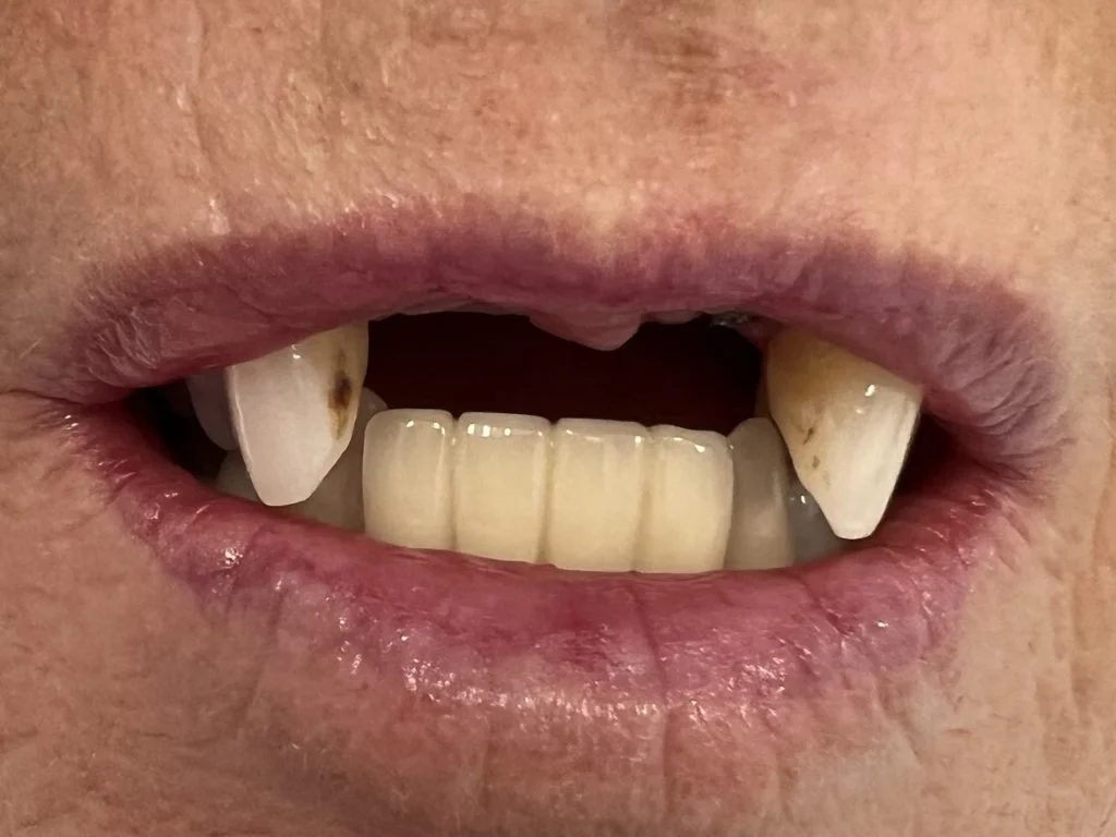 Case 2 - Bridge on 2 implants - Before