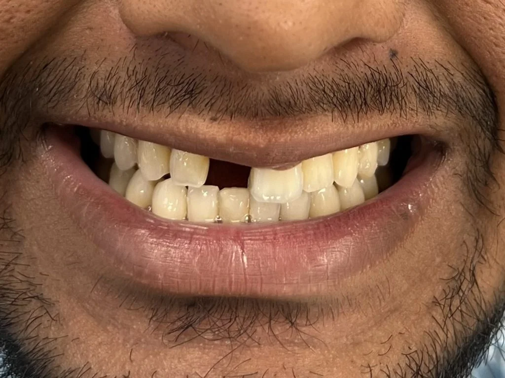 Case 4 - Single implant - Before