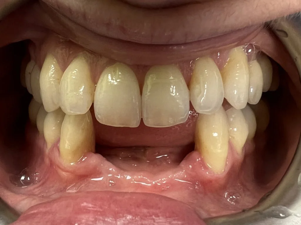 Case 3 - Bridge on 2 implants - Dr. Emilio Cecamore