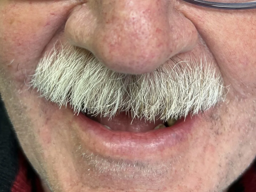 Toronto on 4 implants - Case 1 - Dr. Cecamore