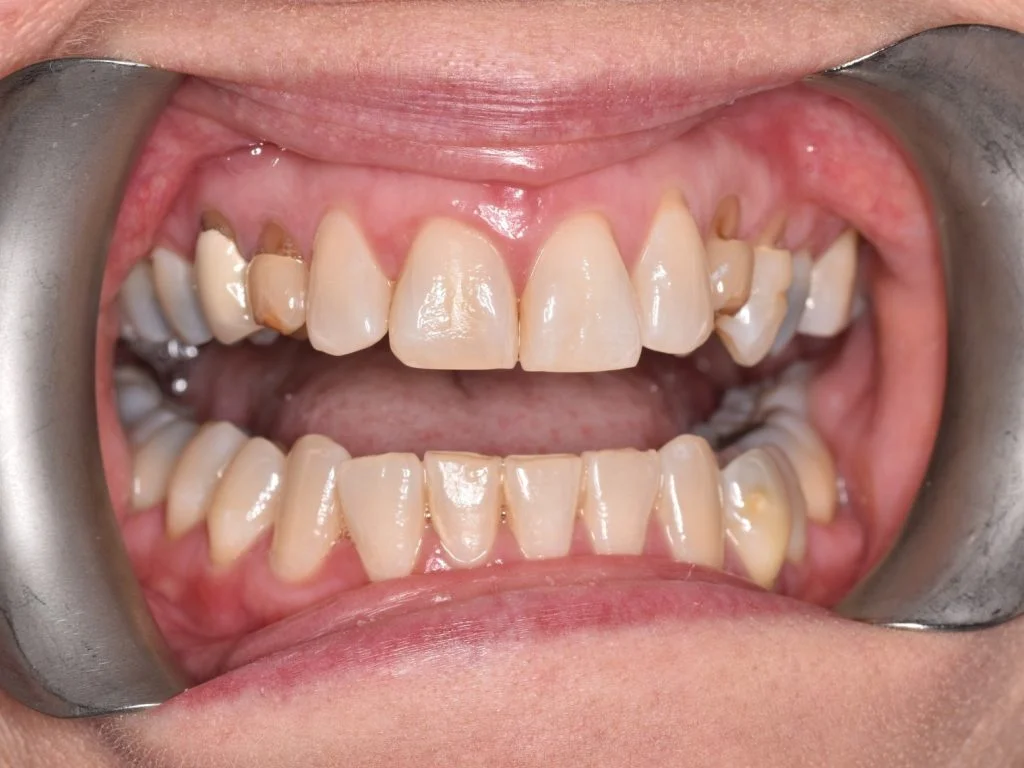 Case 5 - Single implant