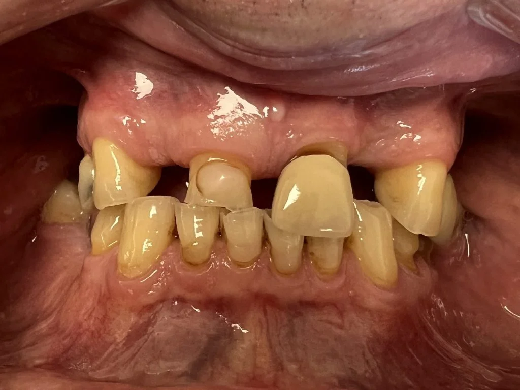 Case 1 - Bridge on 2 implants