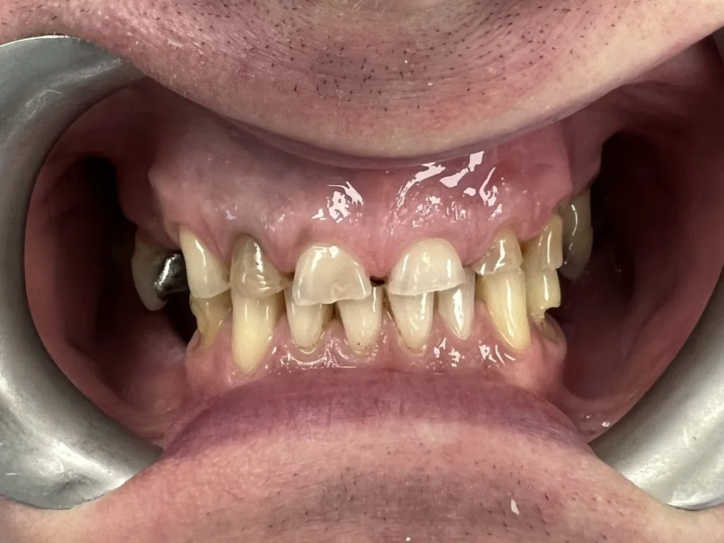 Toronto on 4 implants -Case 3