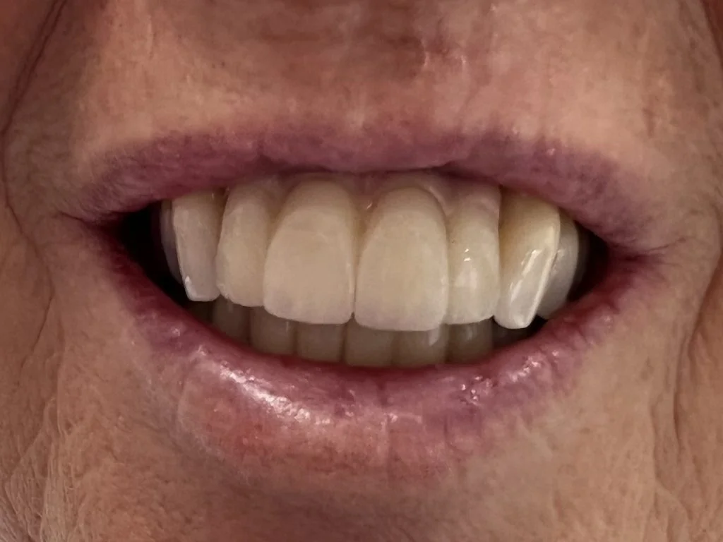 Case 2 - Bridge on 2 implants - Results