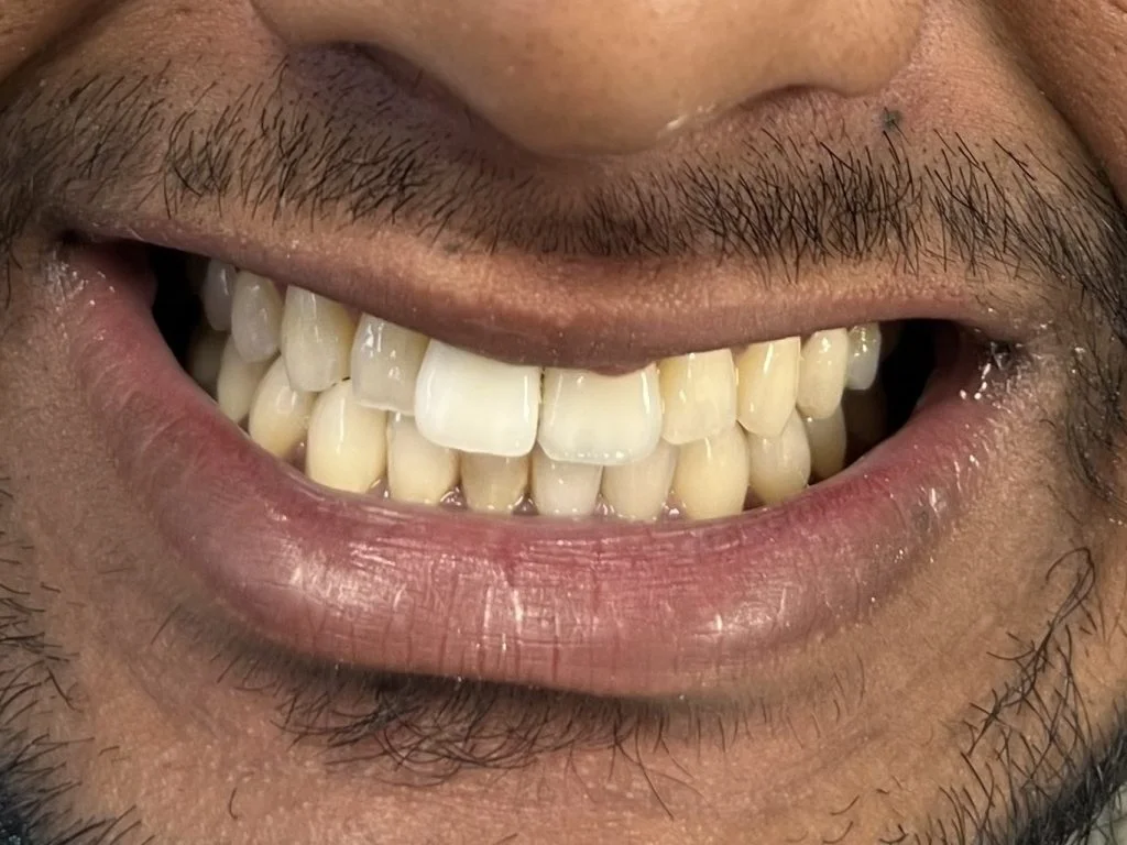 Case 4 - Single implant