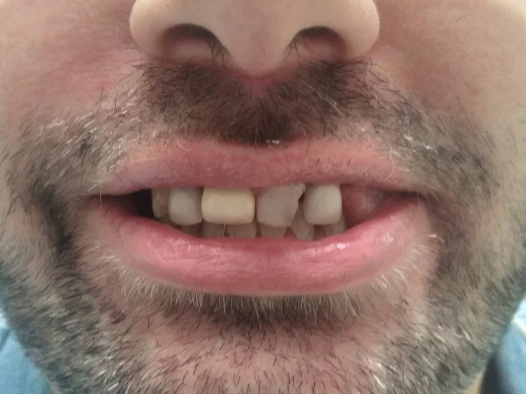 Toronto on 4 implants -Case 2 - Dr. Cecamore