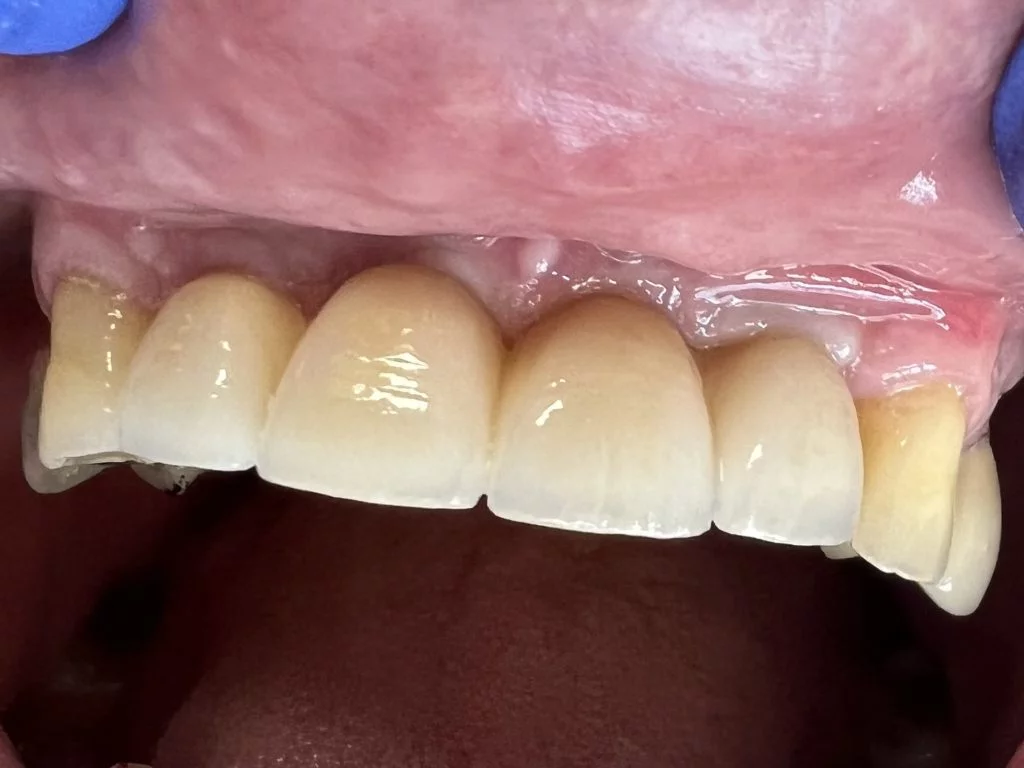 Case 1 - Bridge on 2 implants