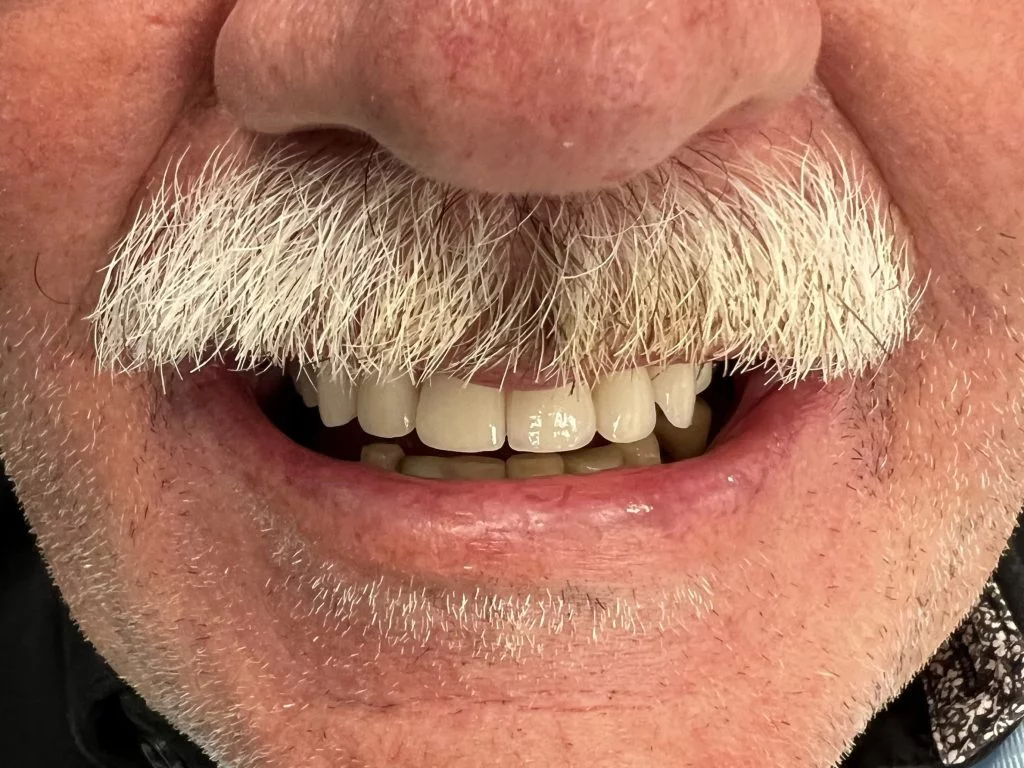 Toronto on 4 implants -Case 1 - Dr. Cecamore