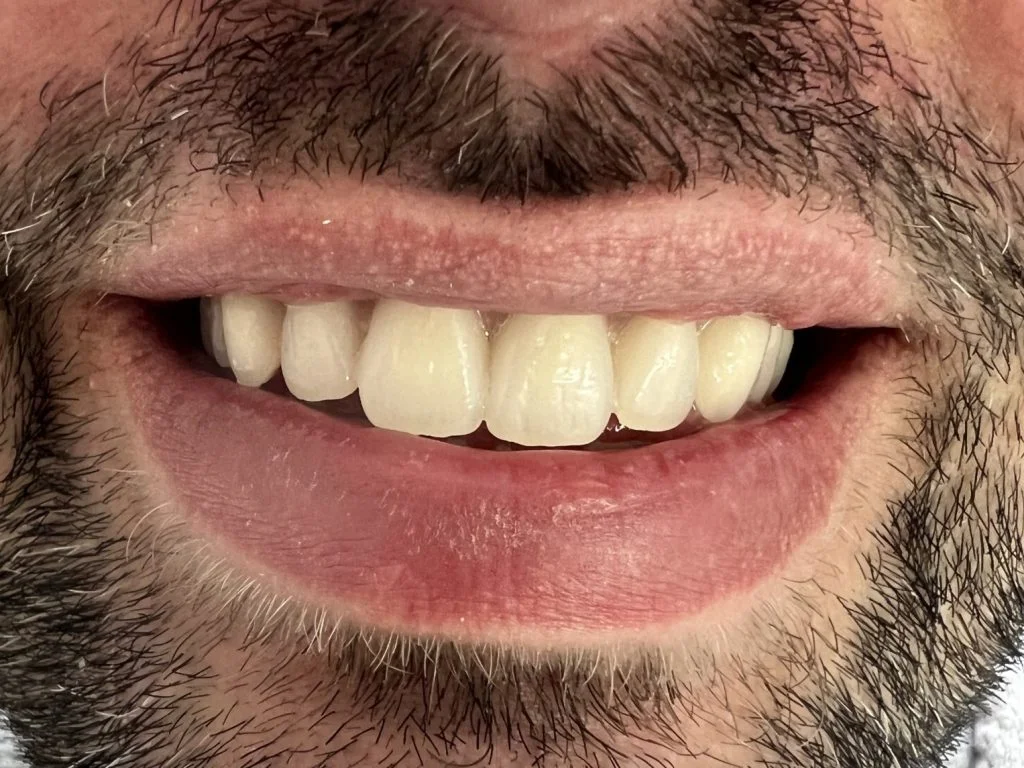 Toronto on 4 implants -Case 2