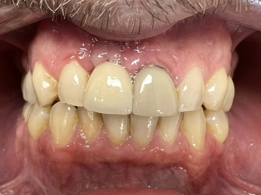 Case 3 - Single implant - Results