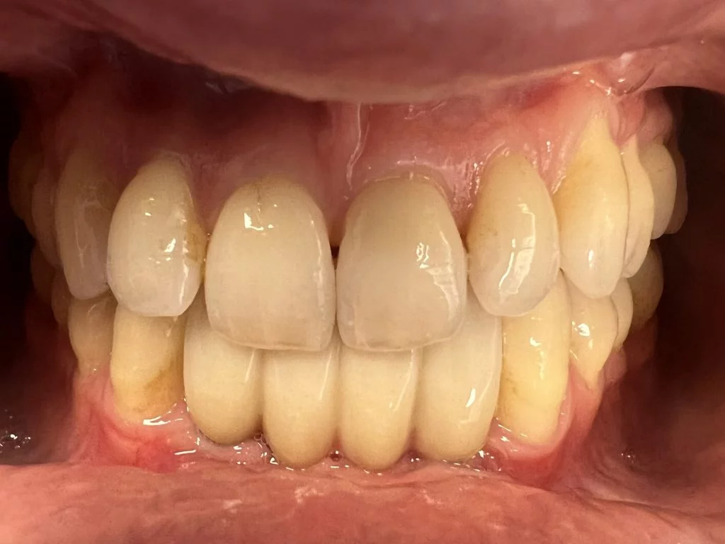 Case 3 - Bridge on 2 implants - Dr. Cecamore