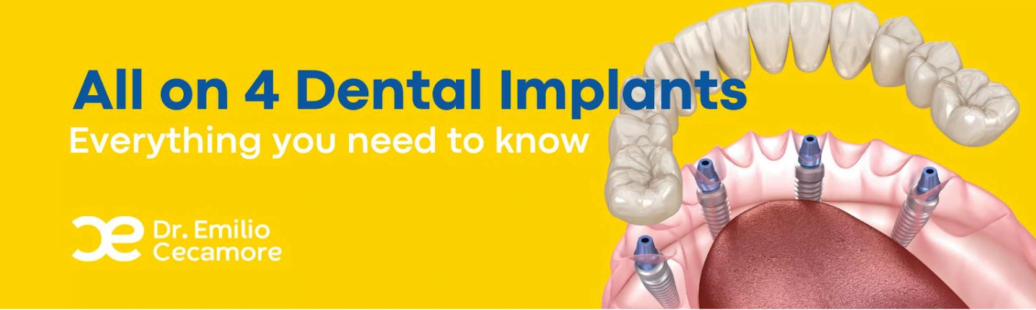 All on four dental implants - Definitive guide