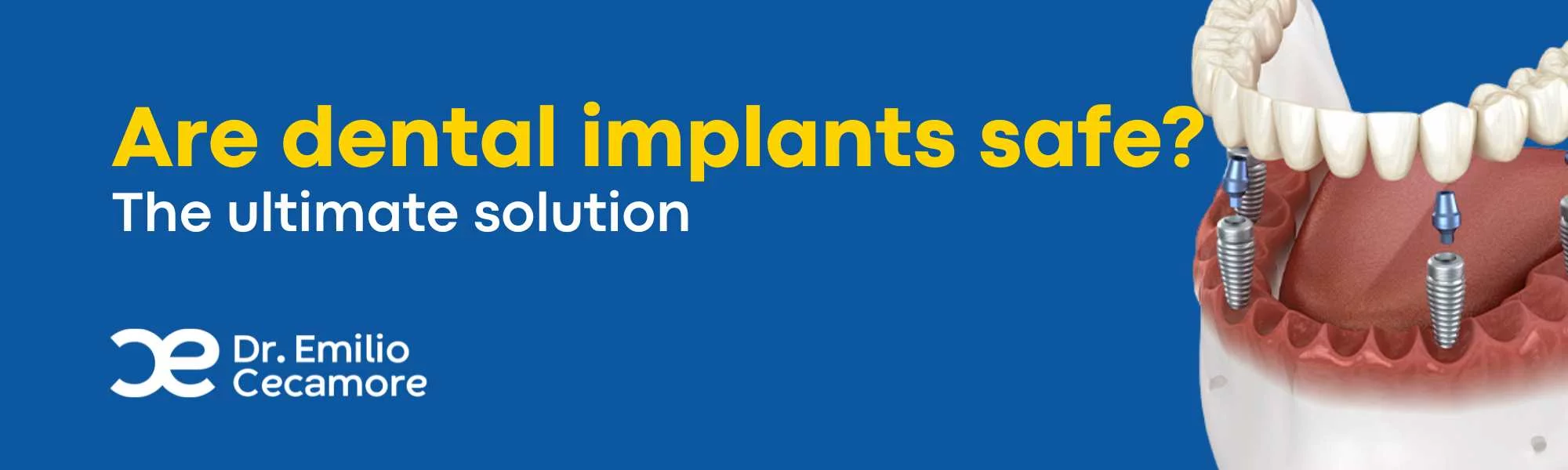 are dental implants safe